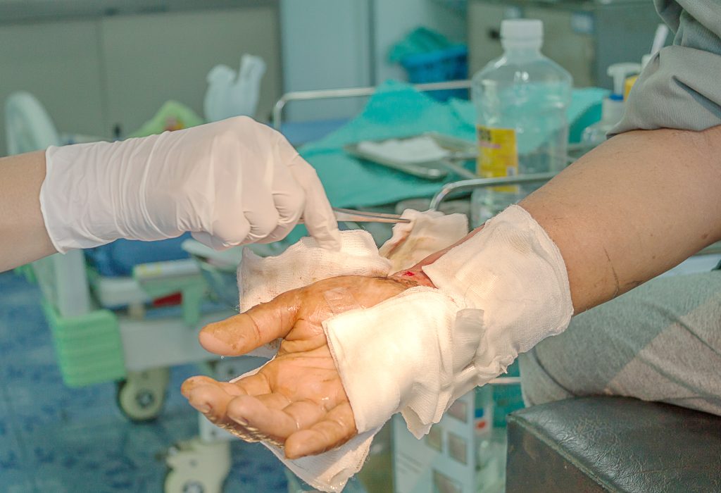 Dressing burned wound