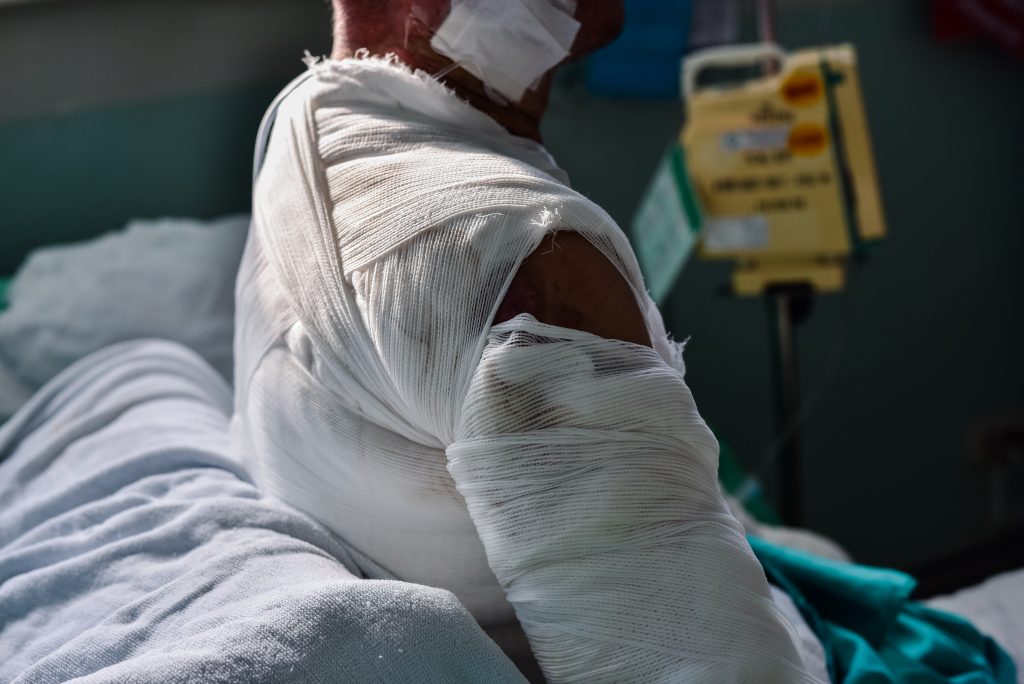 Patient with burns in the hospital.
