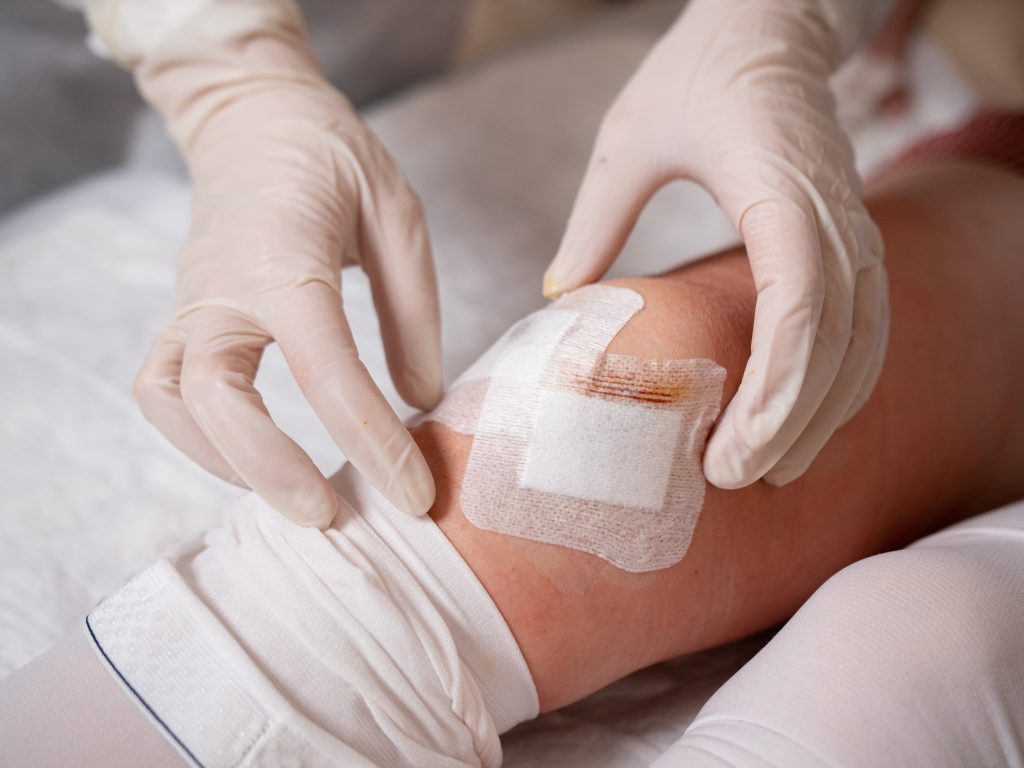 The nurse's hands in medical gloves stick a sterile patch on the incision in the patient's knee after arthroscopy surgery.